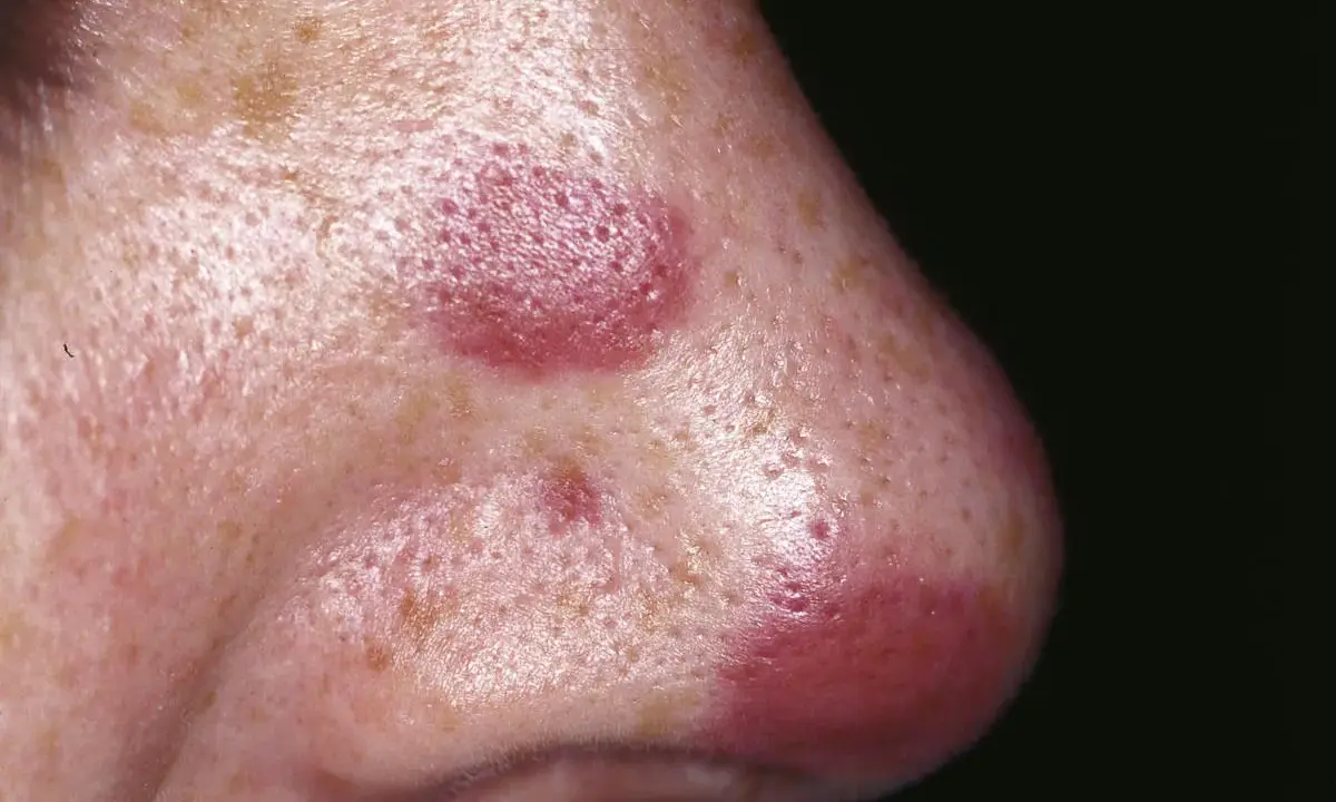 Lesioni cutanee violacee sul naso, indicative di sarcoma di Kaposi.