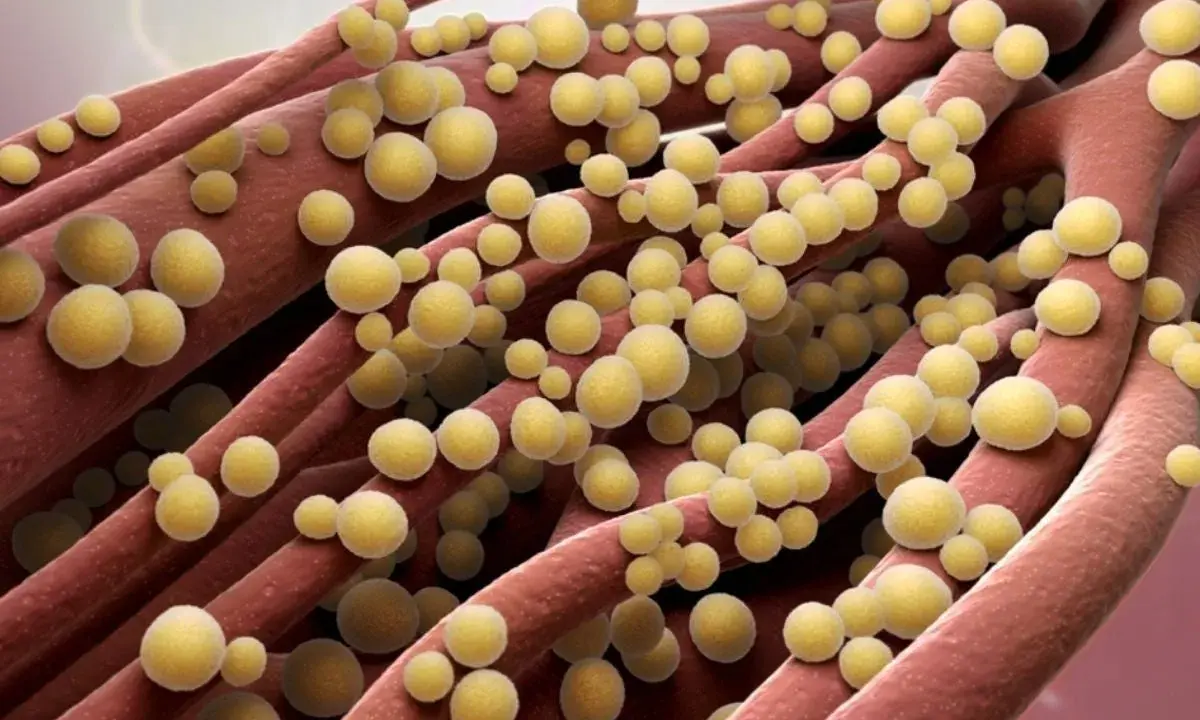 Ingrandimento di fibre rosse con batteri sferici gialli, possibile infezione naso stafilococco.
