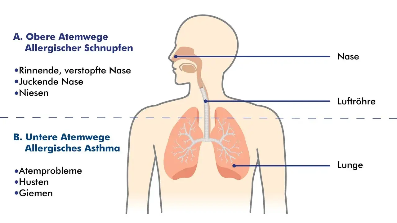 Schema zeigt obere Atemwege (allergischer Schnupfen) und untere Atemwege (allergisches Asthma). So kann man allergisches Asthma behandeln.