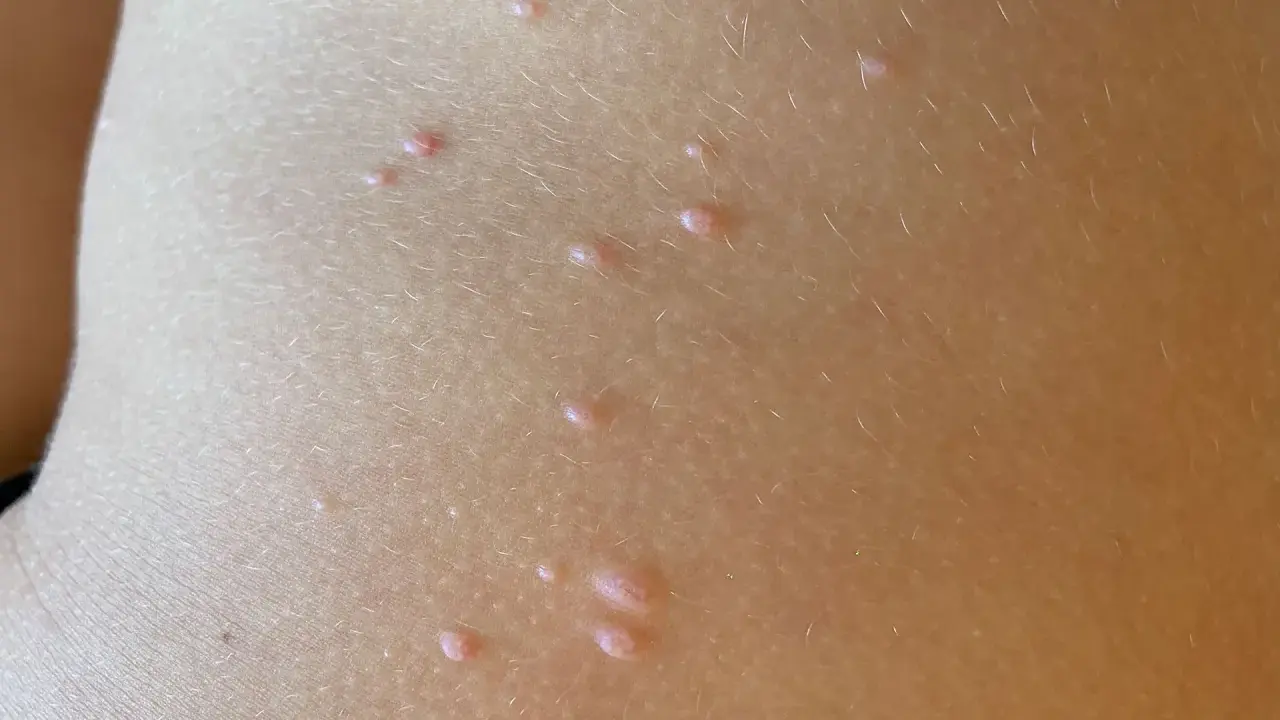 Piccolo dettaglio della pelle di un bambino con molluschi contagiosi, piccole protuberanze rosee che sembrano minuscoli molluschi.
