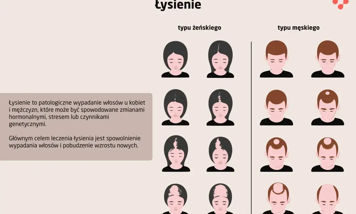 Ilustracja pokazuje różne etapy łysienia androgenowego u kobiet i mężczyzn. Widać stopniową utratę włosów, od przerzedzenia po całkowite wyłysienie.