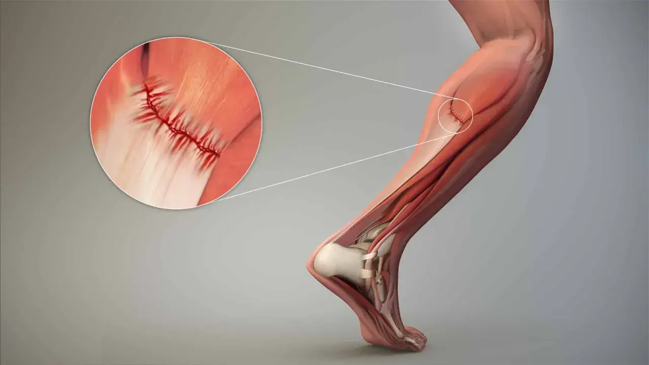 Dettaglio di lesioni muscolari con suture, illustrando il trattamento chirurgico per la riparazione.