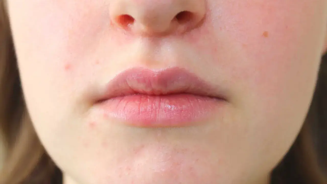 Primo piano del viso con labbra e naso. Si nota una leggera dermatite intorno al naso, con arrossamenti e piccole imperfezioni.