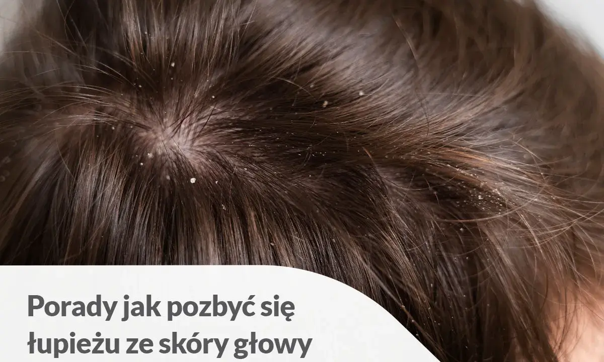 Widoczne białe płatki na ciemnych włosach i skórze głowy. Porady jak pozbyć się łupieżu ze skóry głowy.