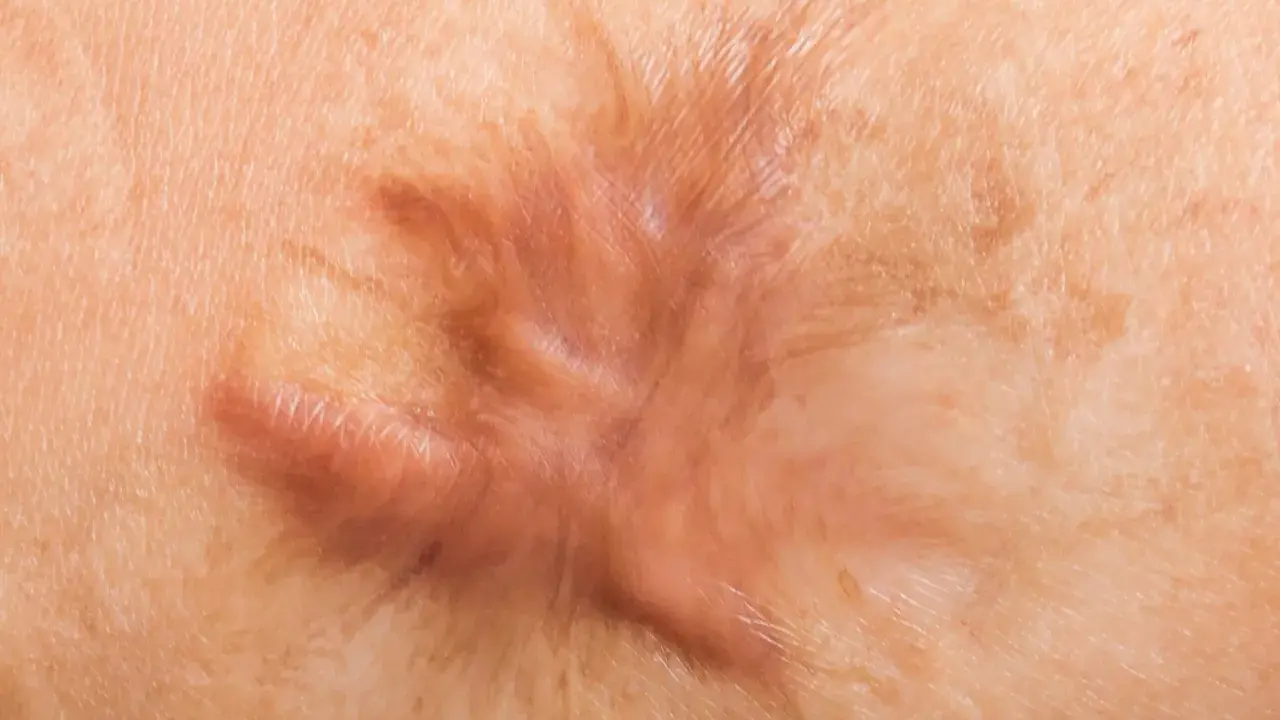 Cicatrice cheloide in rilievo sulla pelle. Esplorare i possibili rimedi per attenuarla.