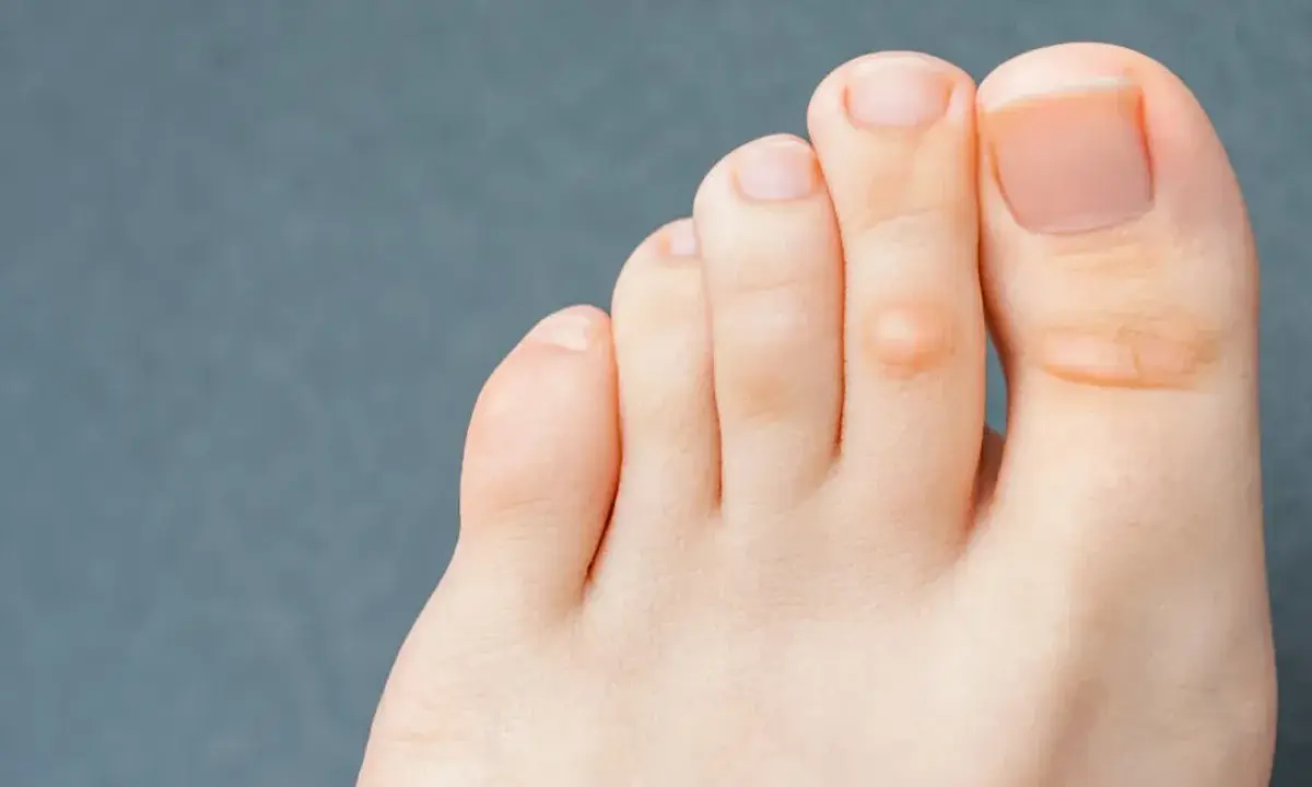 Un pied avec des cors, montrant la nécessité de soigner cors au pied pour retrouver confort et bien-être.