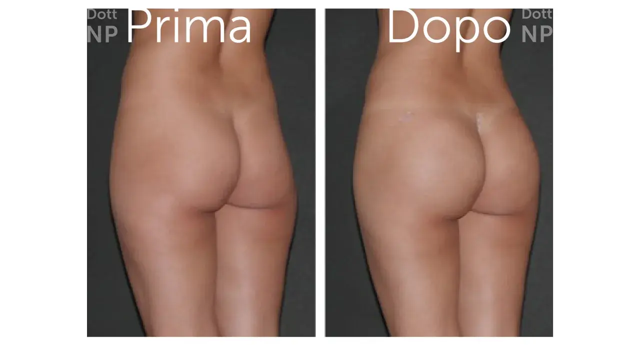 Prima e dopo gluteoplastica senza protesi: un risultato naturale e armonioso.