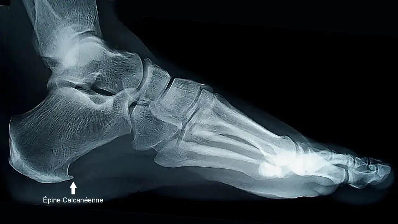Radiographie latérale du pied montrant une épine calcanéenne, indiquant la nécessité d'une prise en charge adaptée.