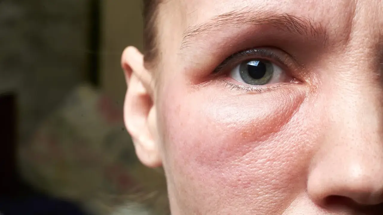 Un visage gonflé, peut-être un œdème, cherche un remède de grand-mère. Gros plan sur l'œil et la joue rougie.