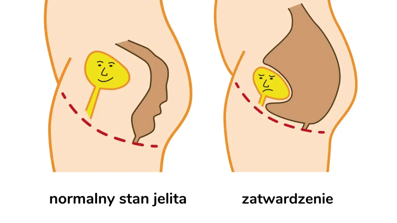 Normalne jelito z uśmiechniętą kupką vs. zatwardzenie z płaczącą kupką, co powoduje ból przy robieniu kupy.