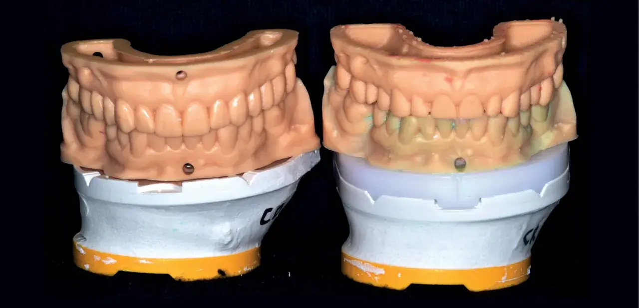 Modele szczęki górnej i dolnej, porównanie przed i po. Podniesienie zgryzu kompozytem cena jest kluczowa dla estetyki.