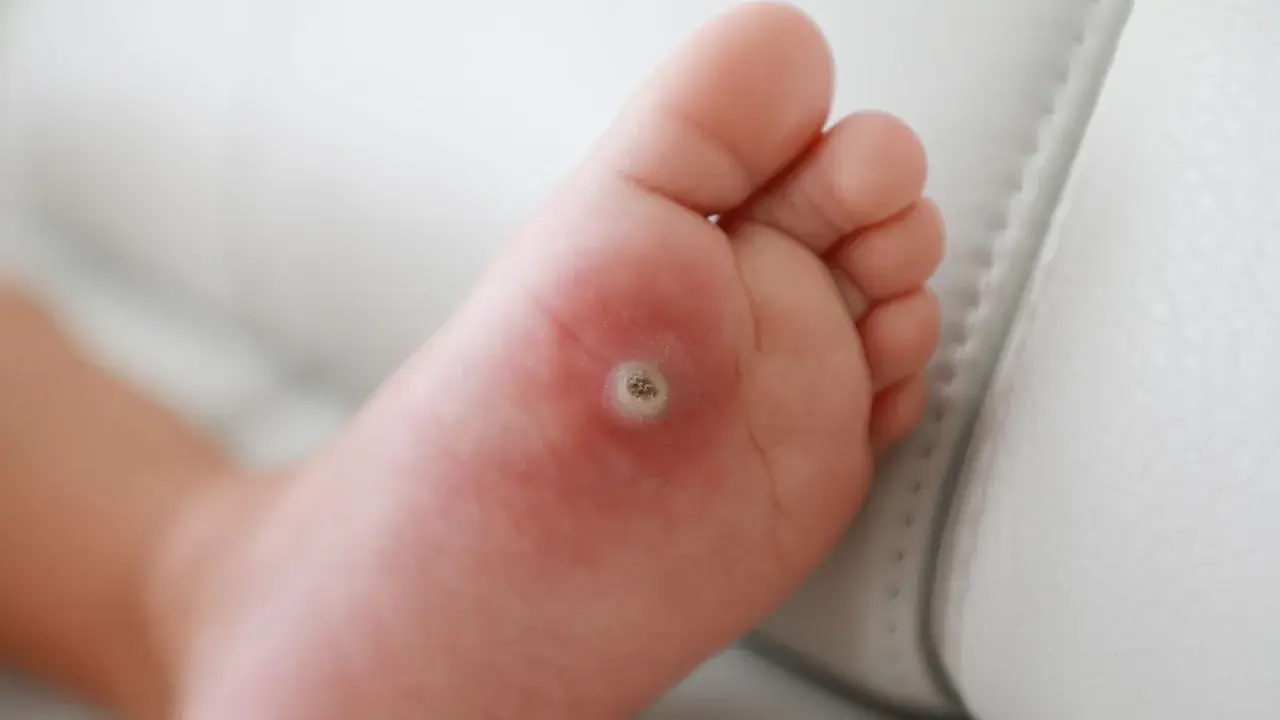 Dziecko ma kurzajkę na stopie, która jest widoczna na podeszwie.