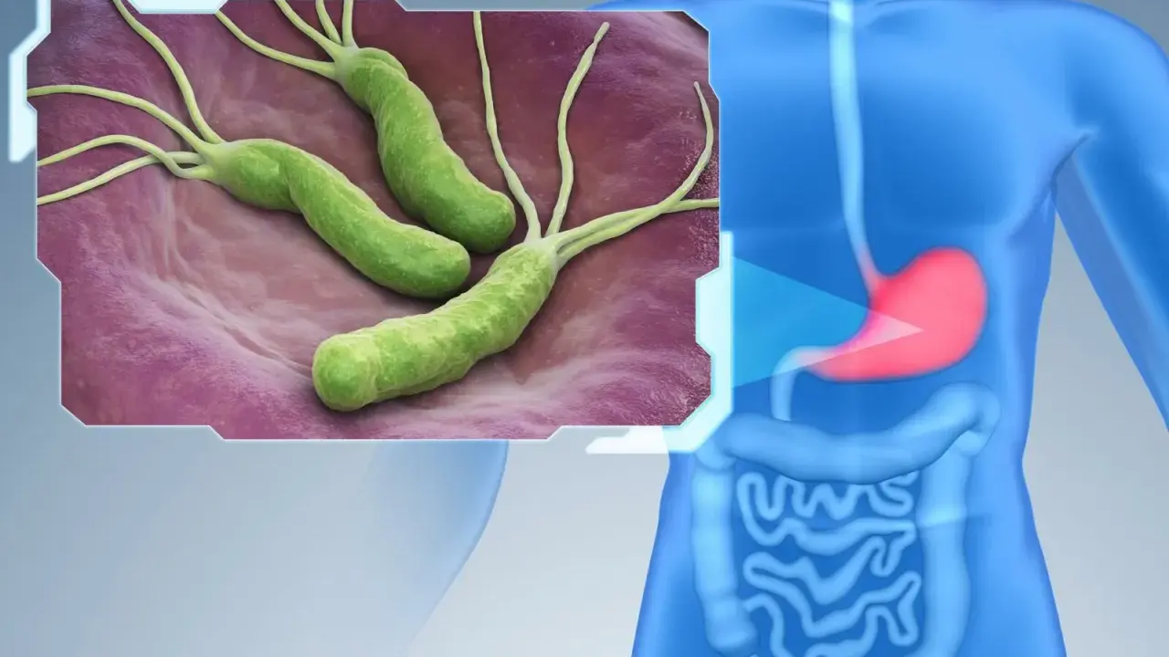 Bakterie Helicobacter pylori w żołądku. Dowiedz się, jak wyleczyć helicobacter.