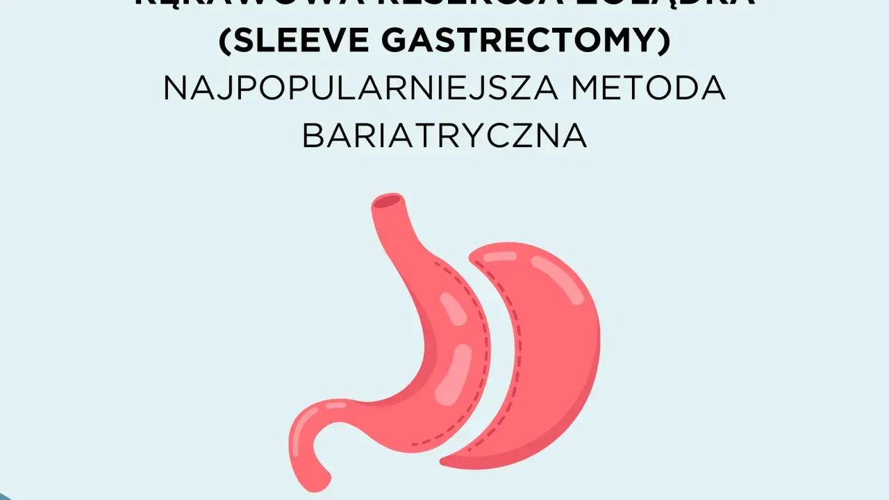 Rękawowa resekcja żołądka, najpopularniejsza metoda bariatryczna, przedstawiona jako stylizowany obraz żołądka.