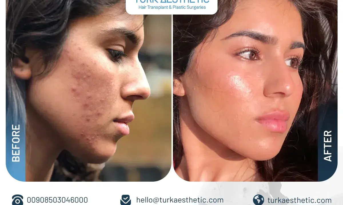 Prima e dopo un trattamento co2 laser viso per acne e imperfezioni. Pelle visibilmente più liscia e luminosa.