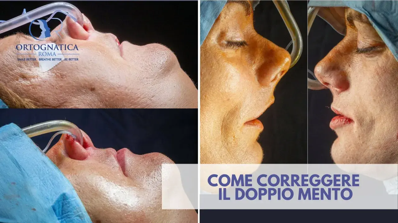 Prima e dopo un intervento per correggere il doppio mento. Immagini ravvicinate del viso di una persona durante una procedura medica.