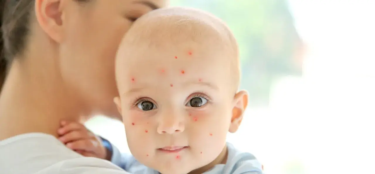 Un bébé est tenu par sa mère, son visage est couvert de petites taches rouges de varicelle.