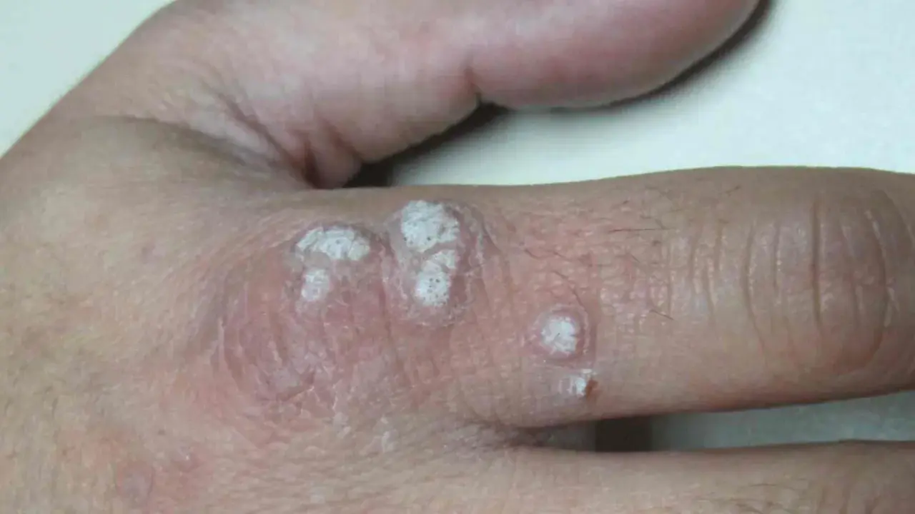 Verrugas en la mano, con aspecto escamoso y blanquecino. La diferencia entre verruga y condiloma es importante para el diagnóstico.