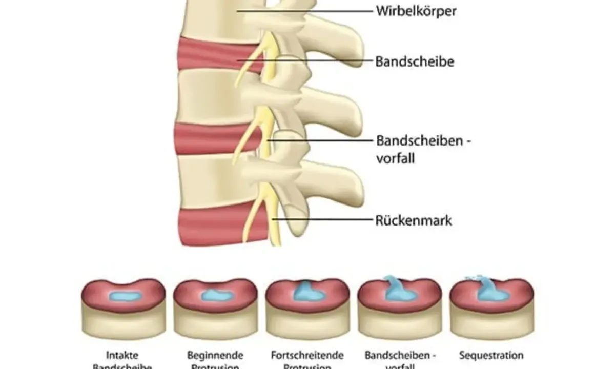 Illustration zeigt Wirbelkörper und Bandscheiben. Unten sind Stadien von Bandscheibenvorfällen abgebildet, von intakt bis Sequestration.