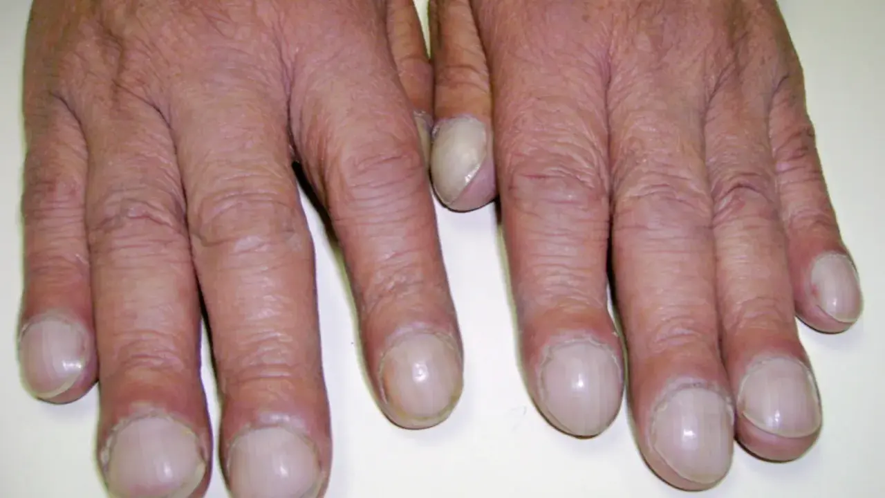 Dita gonfie e unghie arrotondate, segni che possono indicare fibrosi cistica alle mani.