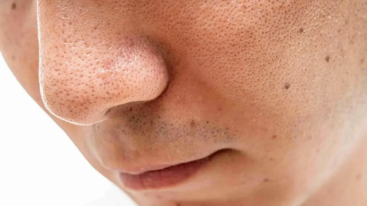 Gros plan sur un nez et une bouche, montrant des pores dilatés et quelques points noirs sur le visage.