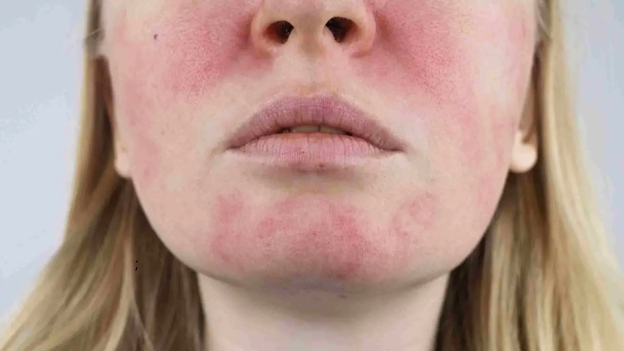 Une tache rouge sur le visage, près des lèvres et des joues, suggère une irritation cutanée.