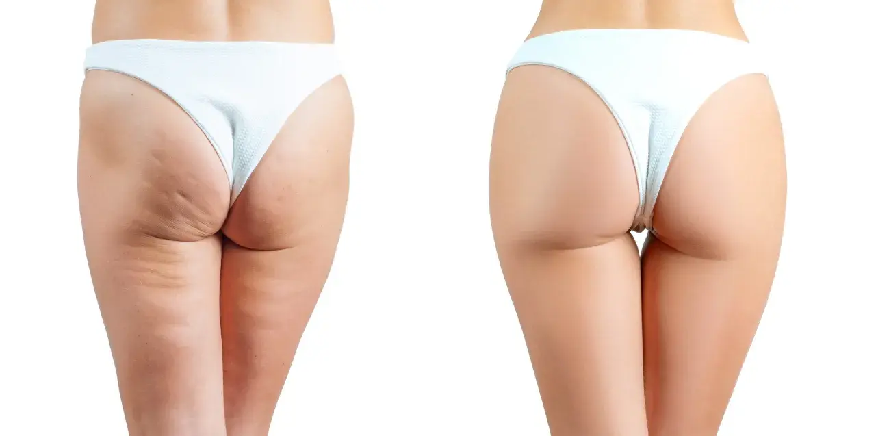 Comparaison avant/après : réduction visible de la cellulite sur les fesses, peau plus lisse et ferme.