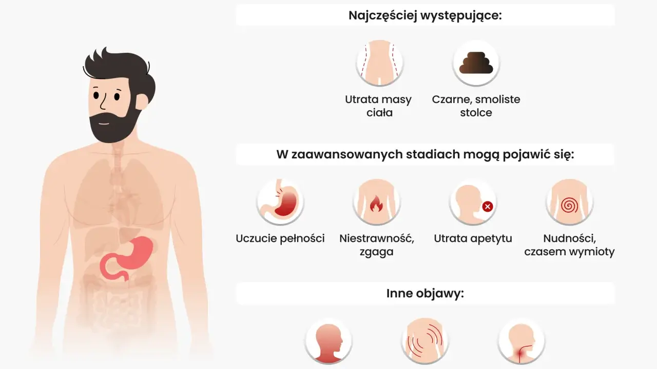 Objawy raka żołądka: utrata masy, czarne stolce, uczucie pełności, niestrawność, zgaga, utrata apetytu, nudności, wymioty, osłabienie, duszność, ból pleców, trudności w połykaniu. Czy rak żołądka boli? Tak, może powodować ból.