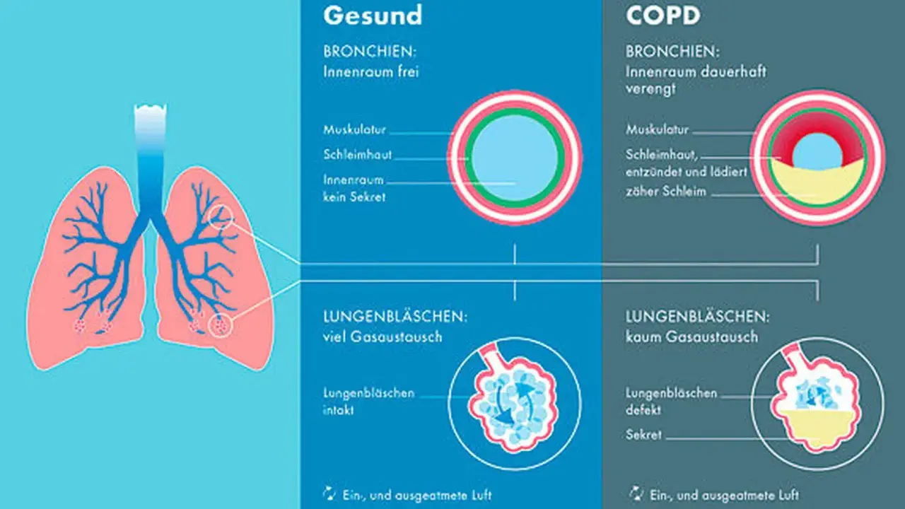 Vergleich gesunder Lungen mit COPD: Verengte Bronchien und defekte Lungenbläschen bei COPD erschweren den Gasaustausch.