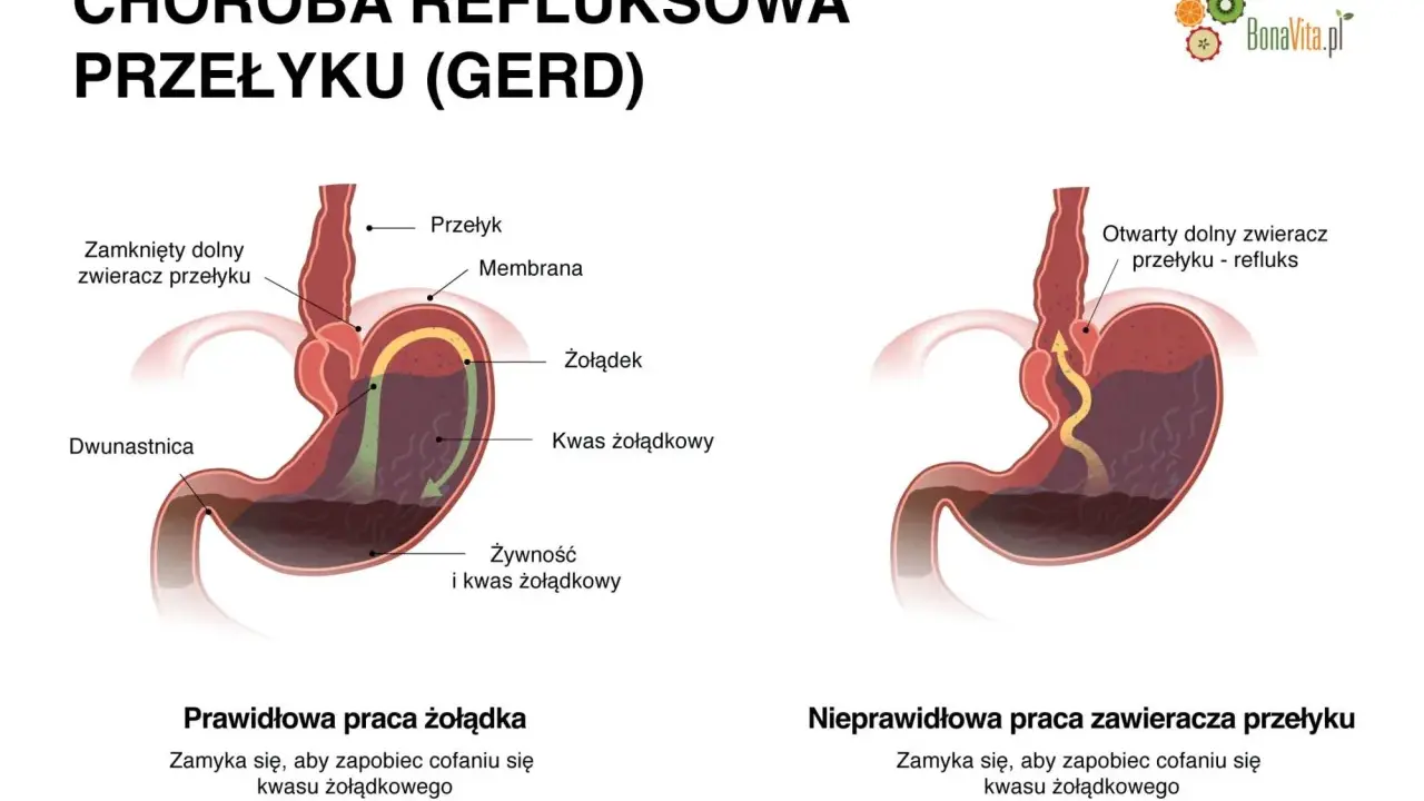 Objawy refluksu u dorosłych: Nie tylko zgaga! Kiedy iść do lekarza?
