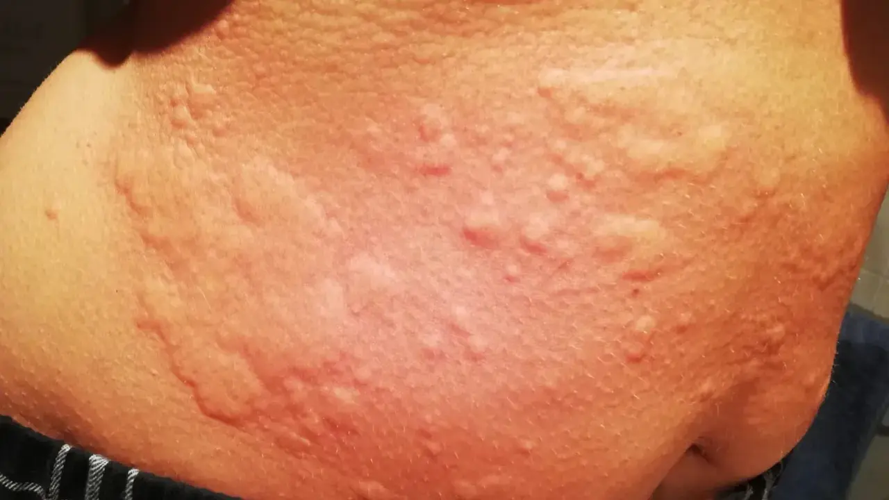 Piel con erupciones rojas y elevadas, posibles síntomas de ácaros en la cama.