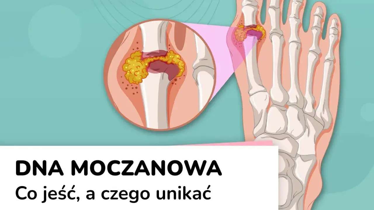 Dna moczanowa: powiększony staw palucha z kryształkami moczanowymi. Wysoki kwas moczowy może prowadzić do bólu.