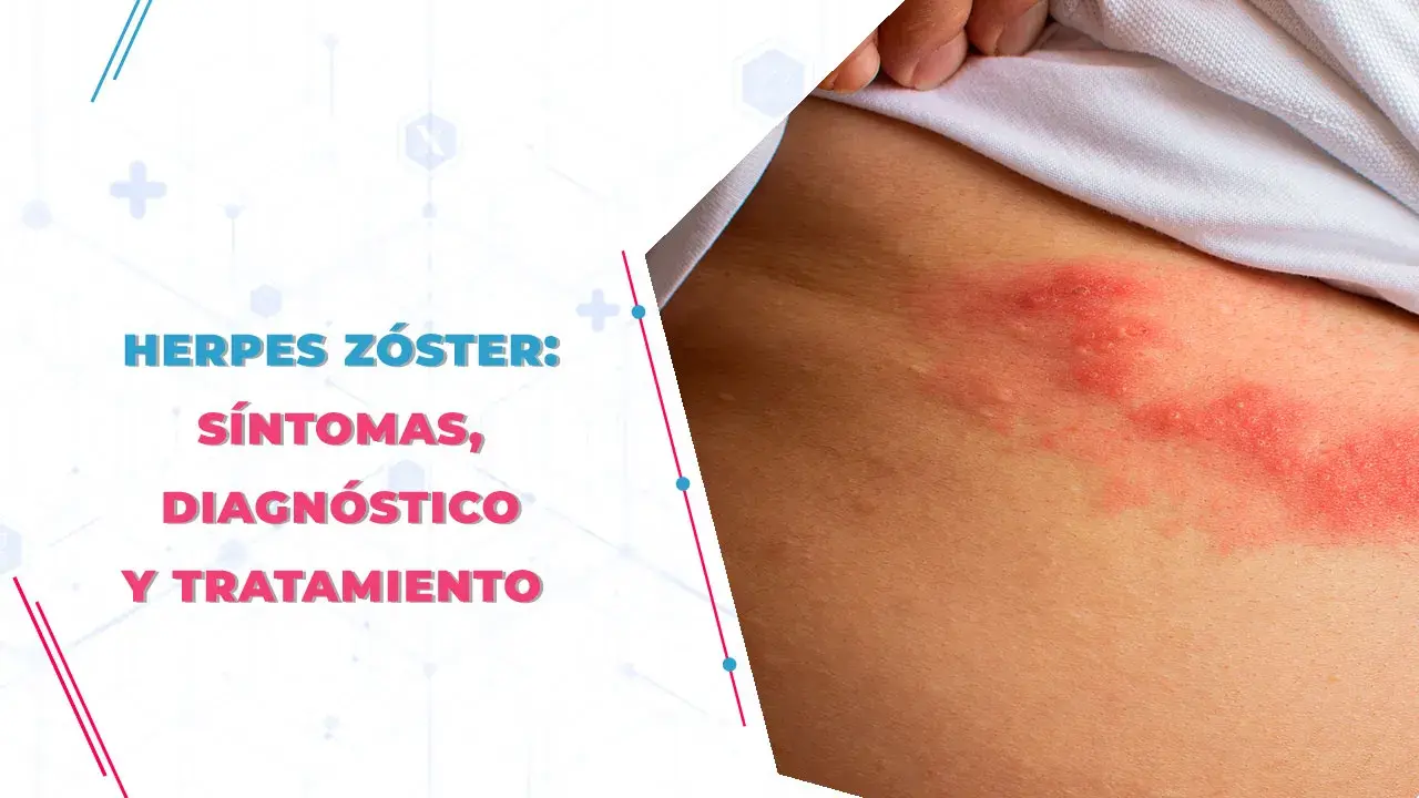 Herpes zóster: Medicamentos esenciales para evitar el dolor crónico