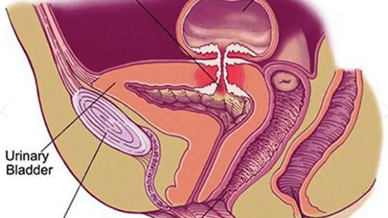 Anatomical diagram showing a colovesical fistula, a connection between the colon and bladder.