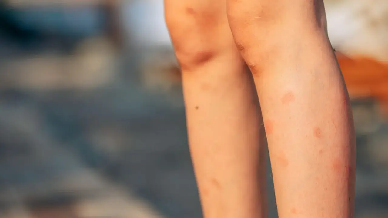 Jambes d'enfant couvertes de rougeurs, un bouton de moustique qui ne part pas, avec quelques éraflures sur les genoux.