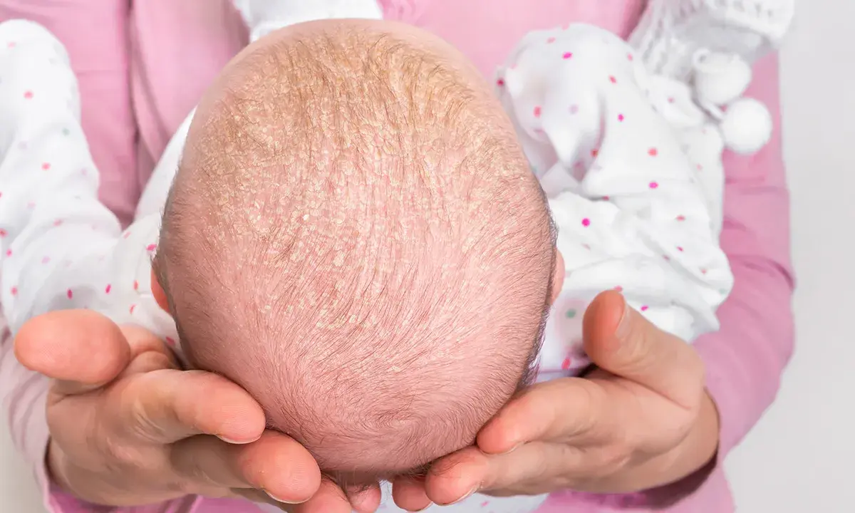 Babykopf mit Schuppen, Anzeichen von trockener Kopfhaut bei Babys.