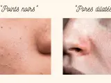 Gros plan sur la peau : points noirs d'un côté, et de l'autre, une zone avec des pores dilatés, suggérant un traitement.