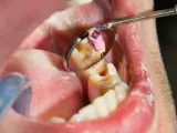 Dentysta wykonuje leczenie kanałowe martwego zęba, używając narzędzi widocznych w lusterku stomatologicznym.
