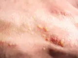 Haut mit kleinen, gelblichen Pusteln, die auf Mallorca Akne hindeuten.