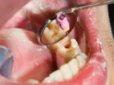 Dentysta podczas leczenia kanałowego zęba. W odbiciu lusterka widać narzędzie stomatologiczne i różowy kołeczek z oznaczeniem rozmiaru.