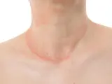 Piel con erupción rojiza y escamosa en el cuello, sugiriendo la presencia de hongos en el cuello.