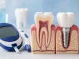 Glukometr i modele zębów, w tym implant, symbolizują troskę o higienę jamy ustnej przy cukrzycy insulinoniezależnej.