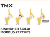 Illustration von 4 Phasen des Morbus Perthes am Hüftgelenk.