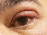 Obrzęk i zaczerwienienie powieki górnej, widoczny jest guzek, który pokazuje jak wygląda jęczmień na oku.