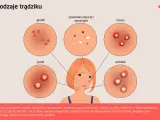 Ilustracja przedstawia różne rodzaje trądziku: grudki, zaskórniki, krosty, guzki i torbiele.