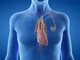 Anatomical illustration of a human heart with a pacemaker. Zastanawiasz się, ile się czeka na wszczepienie rozrusznika serca?