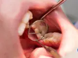 Dentysta bada zęby, widoczne są oznaki chorób zębów, takie jak ubytek.