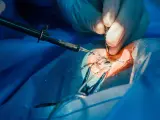 Dettaglio di un intervento glaucoma con tubicino, mani guantate usano strumenti chirurgici sull'occhio.