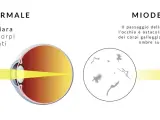 Confronto occhio normale e miodesopsia: corpi galleggianti nel vitreo ostacolano la luce. Ricerca cure naturali per il distacco del vitreo.
