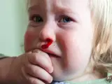 Małe dziecko z krwawiącym nosem. Krwawienie z nosa z jednej dziurki może mieć różne przyczyny, np. uraz lub suchość.